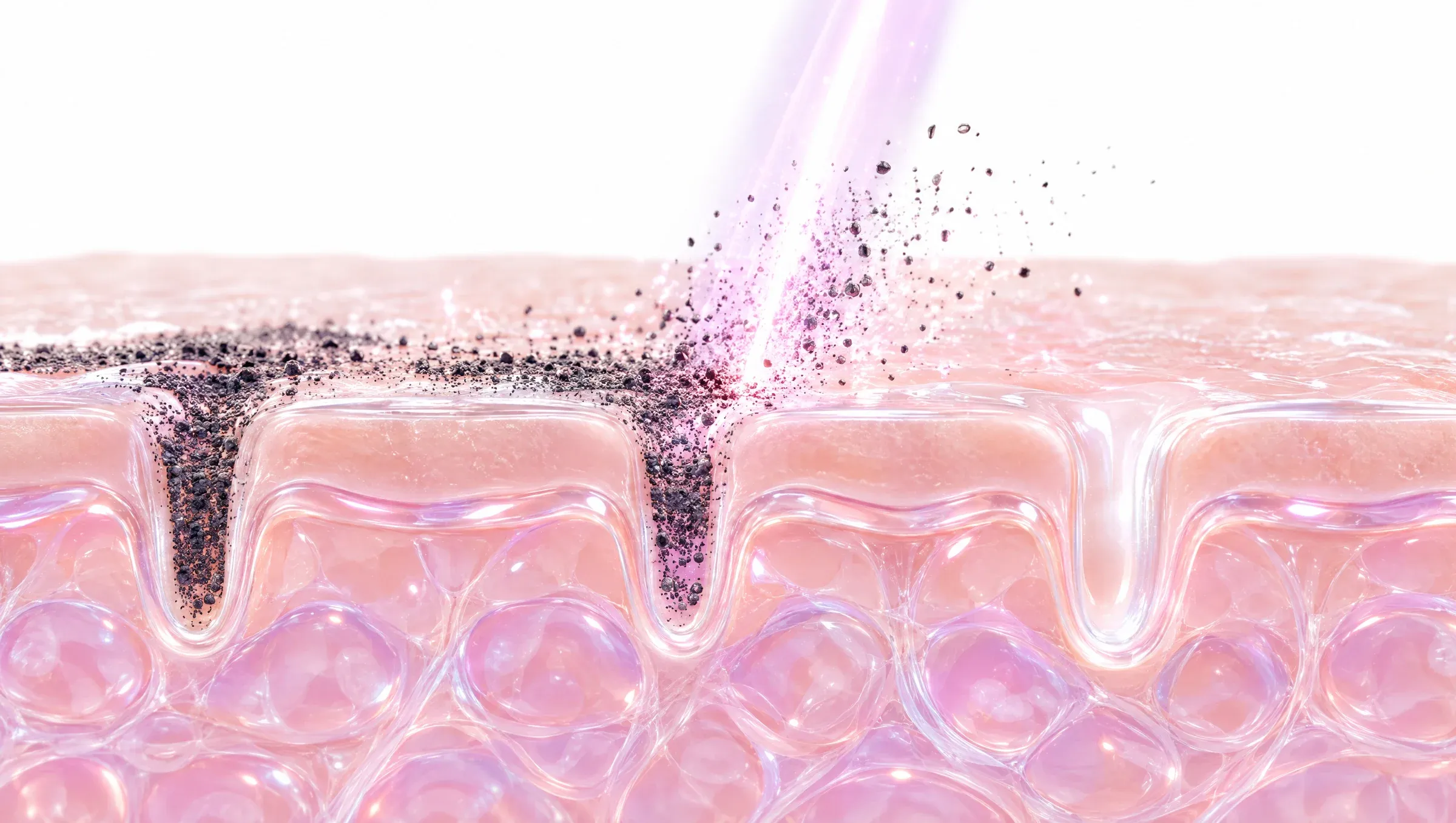 Illustration: fine carbon particles in the pores being lifted away by laser light, leaving the surface clean and bright.